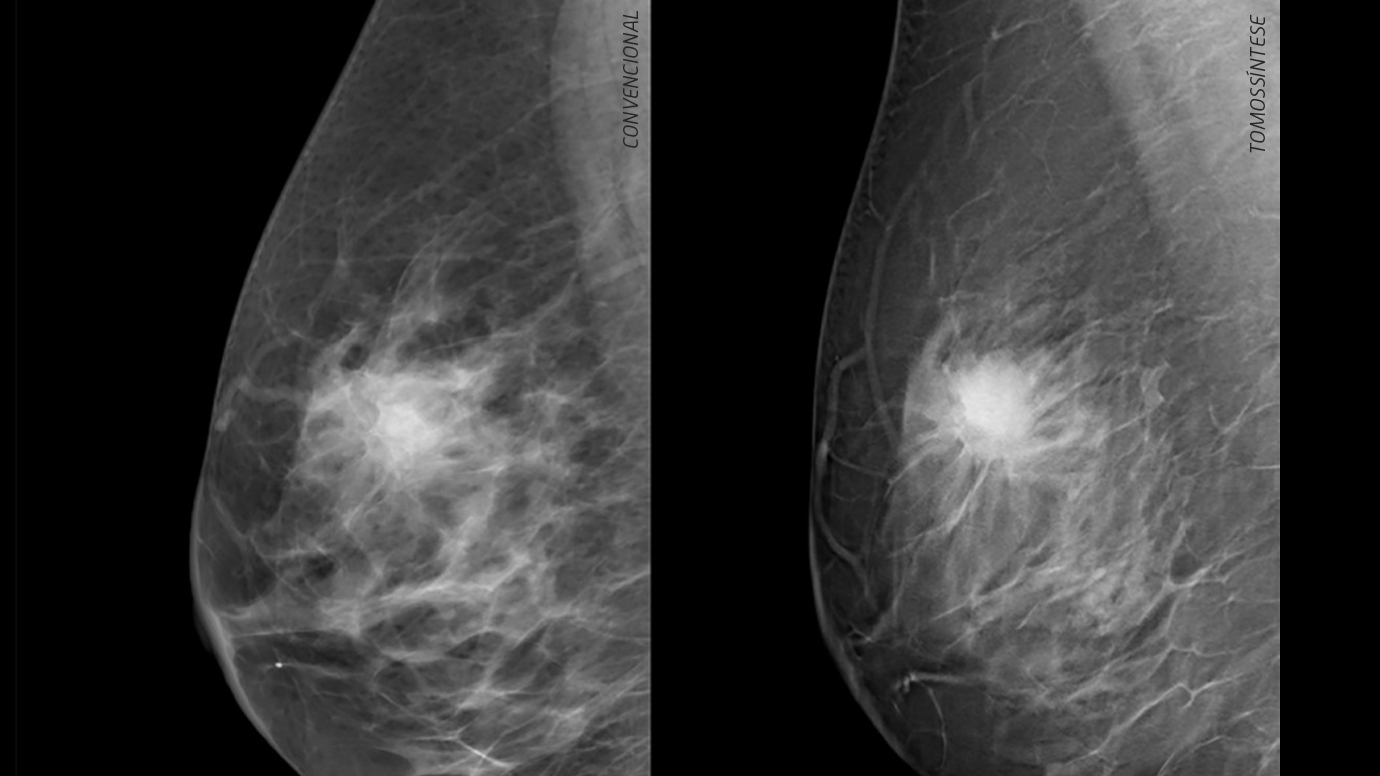 imagem mamografia