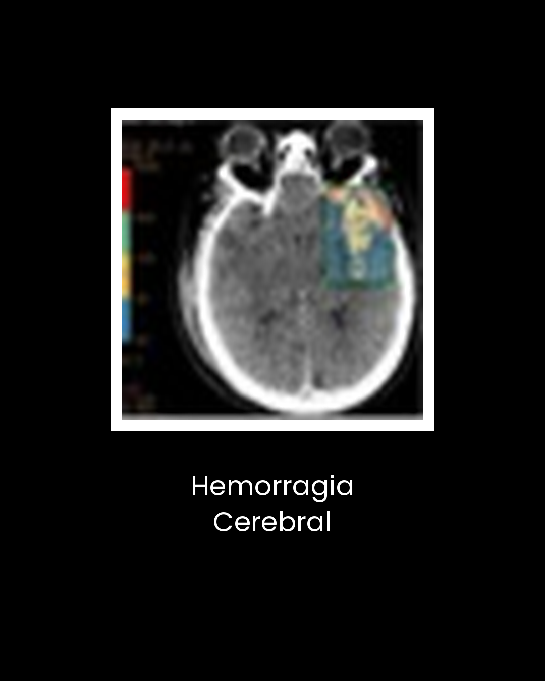 01-hemorragia-cerebral