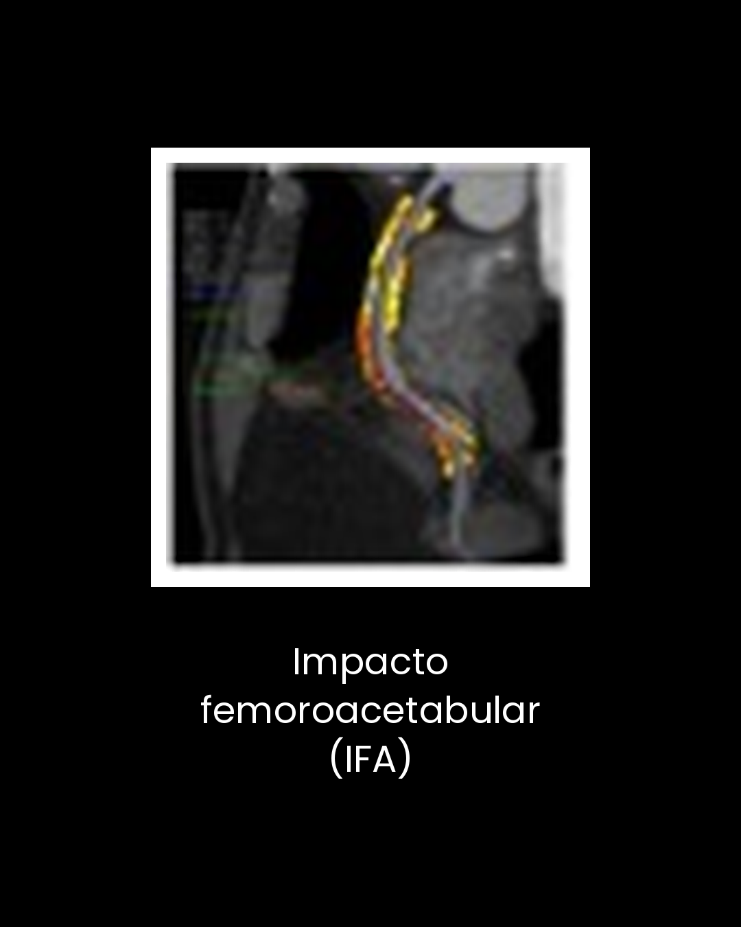 02-impacto-femoroacetabular-ifa