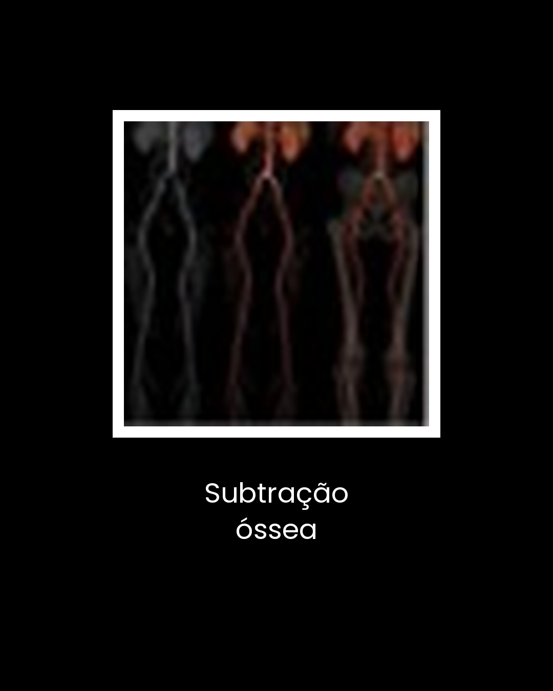 12-subtracao-ossea