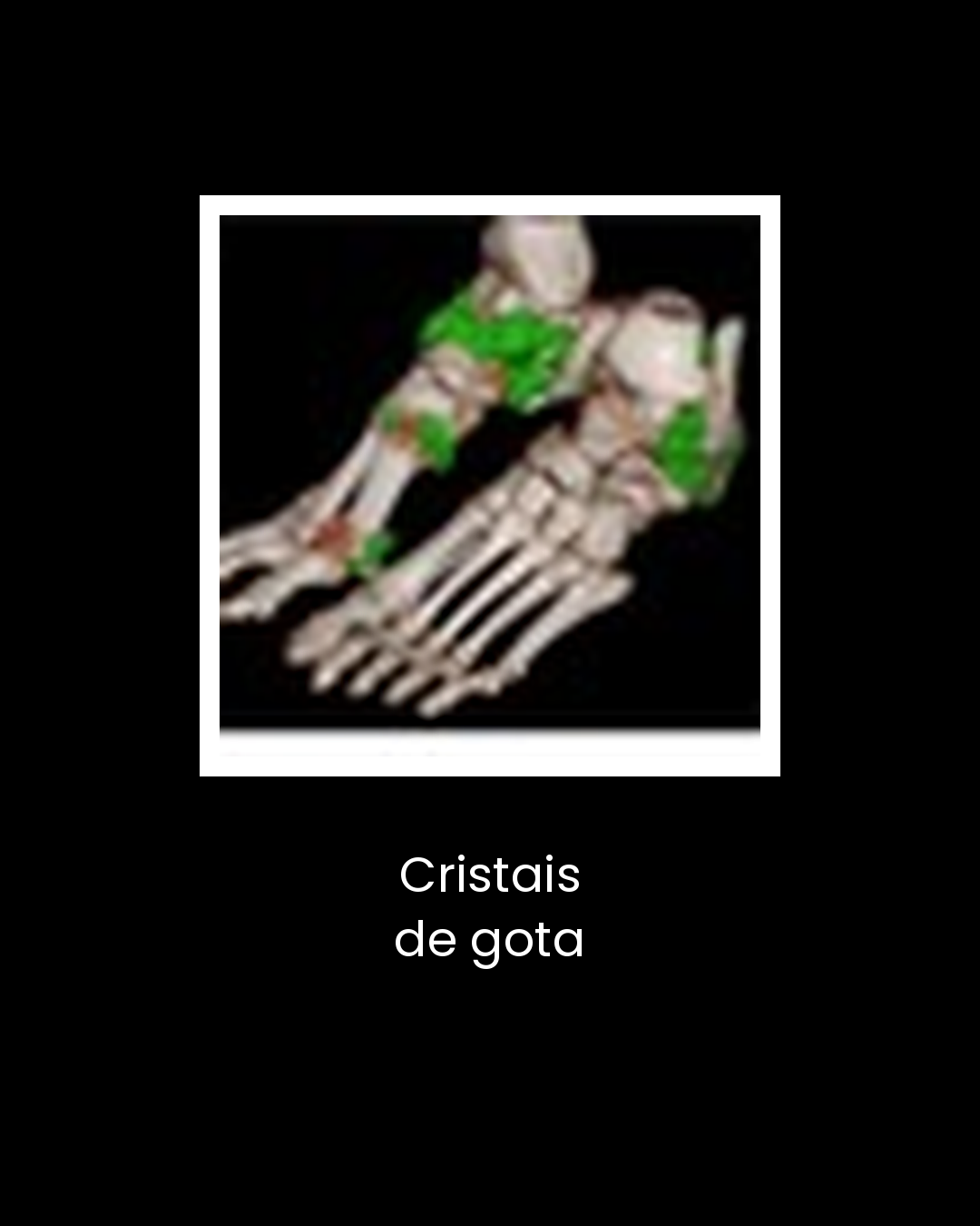 17-cristais-de-gota